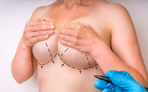 Brustverkleinerungsoperation Izmir, Türkei