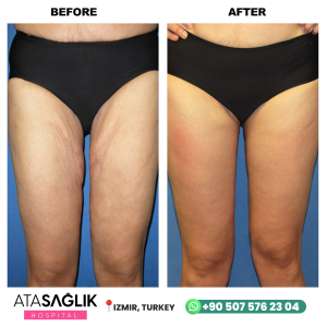 Liposuction in Turkey