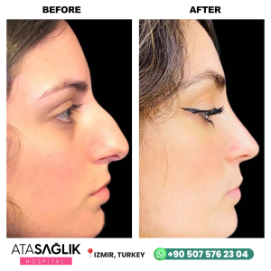Rhinoplasty