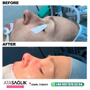 Rhinoplasty