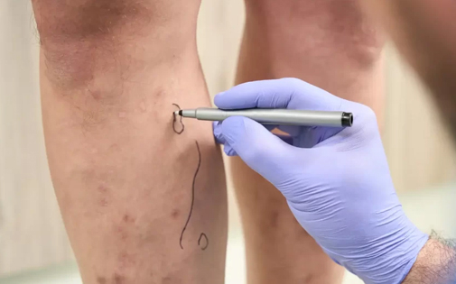 Varis Tedavisi İzmir